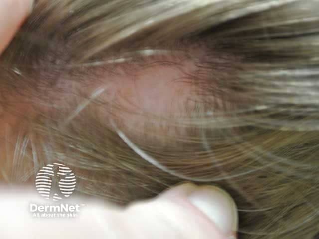 Pediatric patient with alopecia areata | Image Credit: © dermnetnz.org