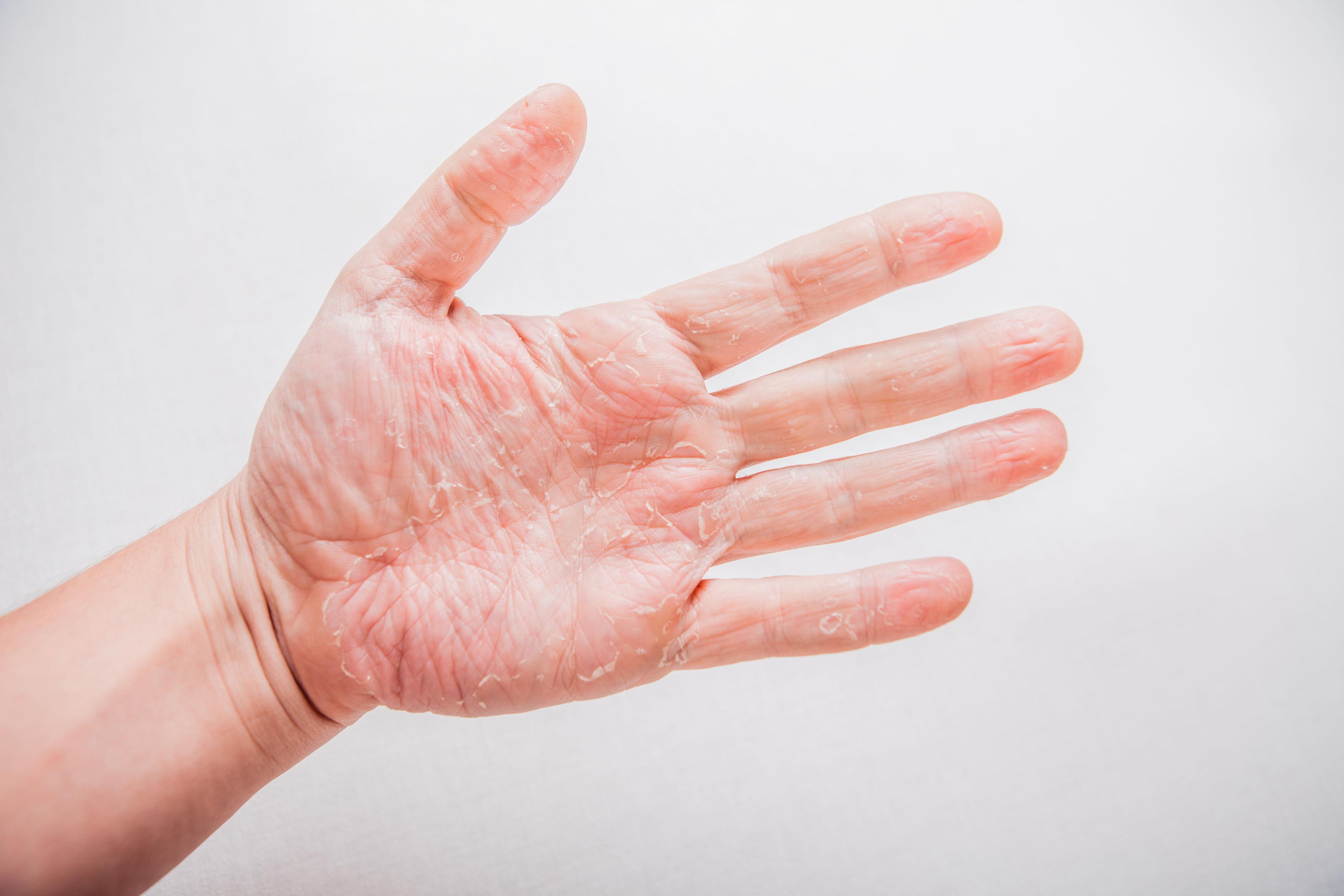 Eczema on the hand