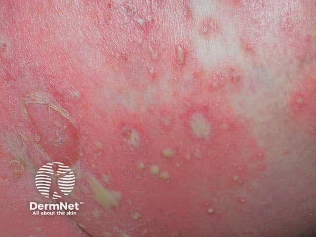 generalized pustular psoriasis | Image Credit: © dermnetnz.org