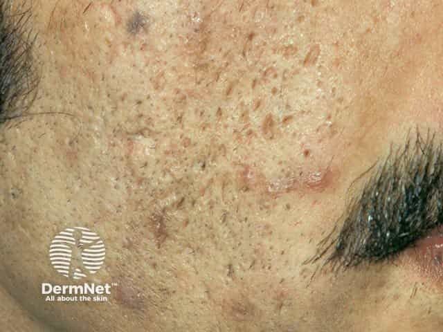 Addressing Acne Scarring Concerns Among Patients