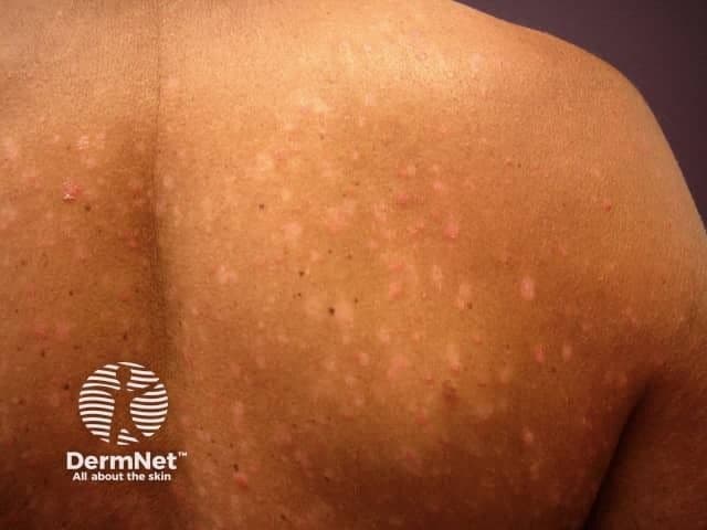 Patient with plaque psoriasis | Image Credit: © DermNet