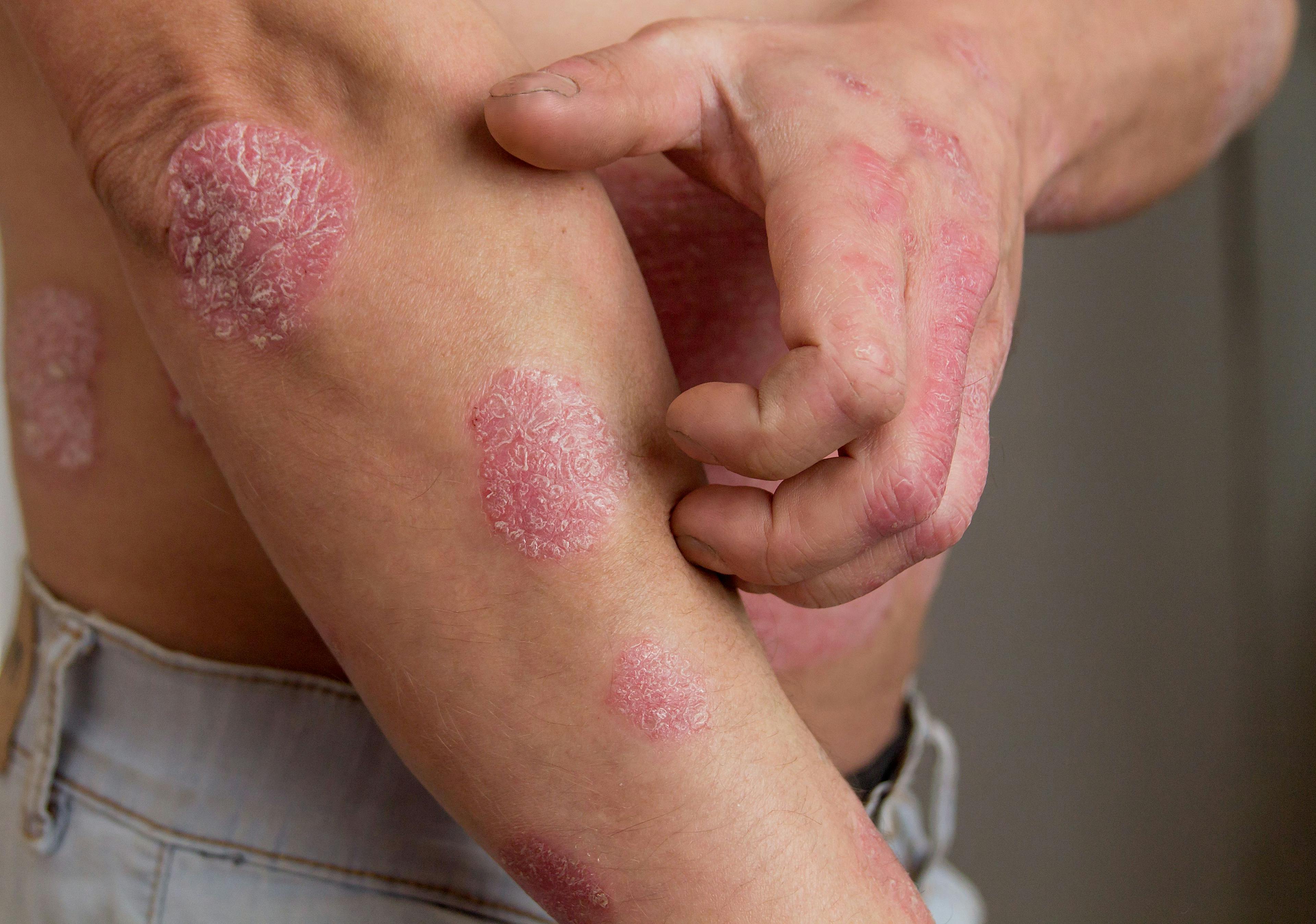 Man with psoriasis on the hands, arm, and abdomen