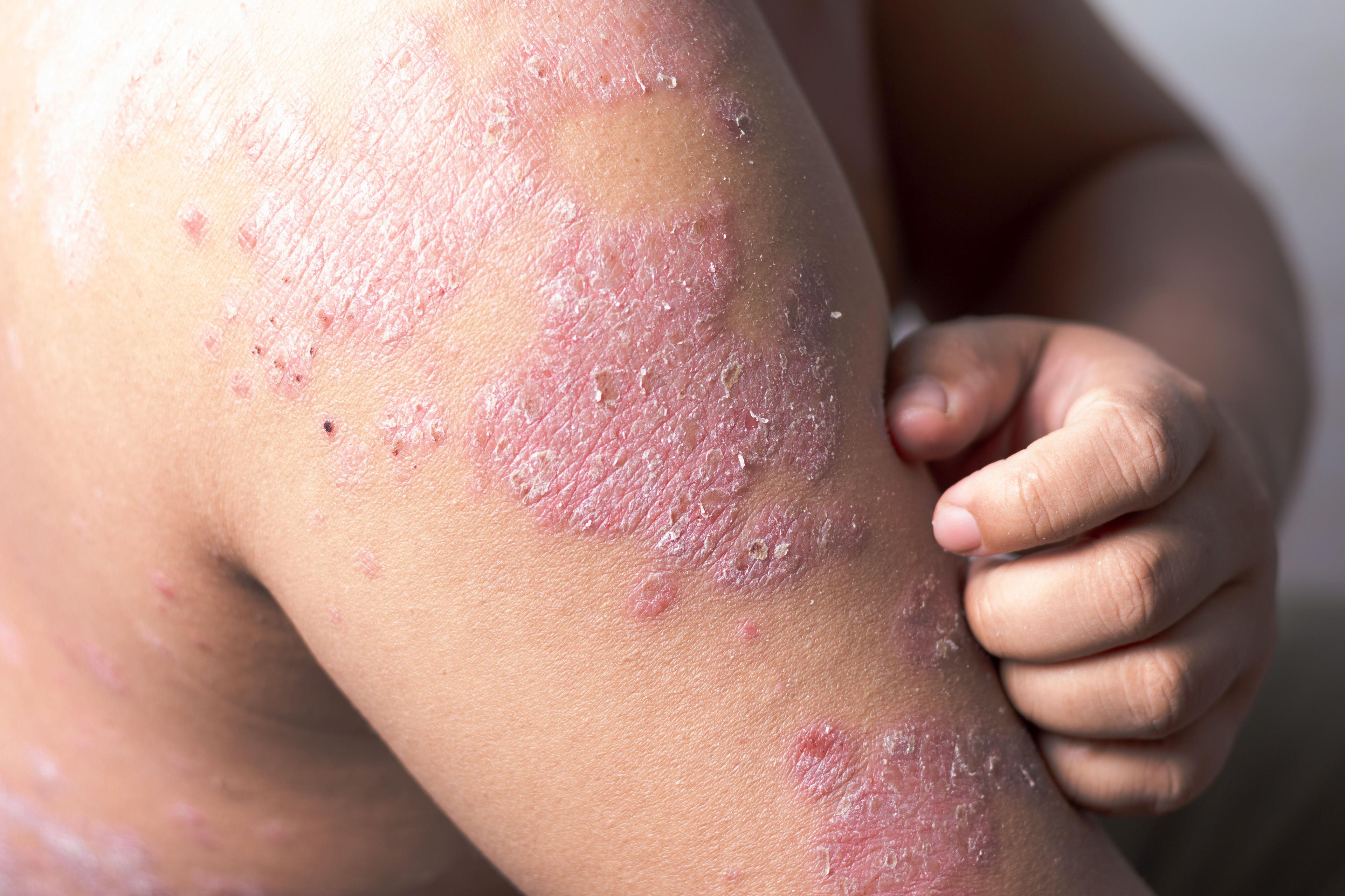 Patient with psoriasis on arms | Image Credit: © Nikkikii - stock.adobe.com