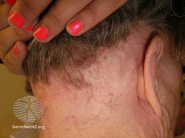 Ophiasic pattern alopecia areata | Image credit: DermNet