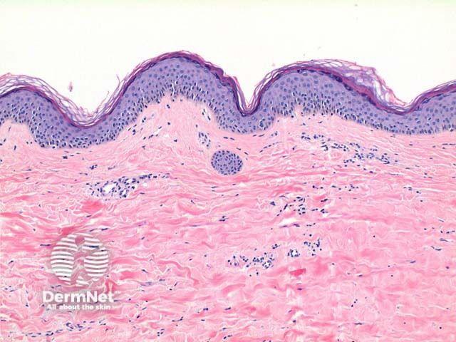 Lichen sclerosus pathology | Image credit: DermNet