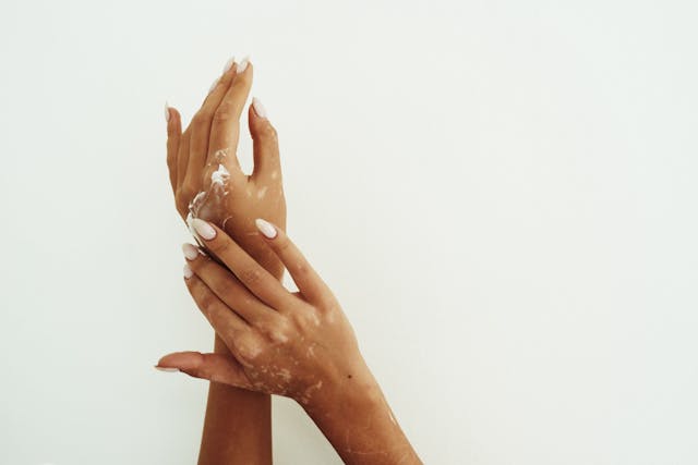 Review: Serum Concentrations of Vitamin D, Vitamin E, and Zinc Lower in Patients With Vitiligo