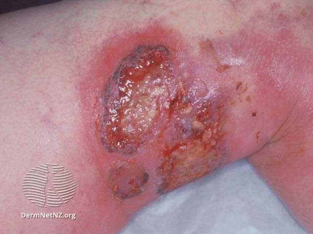 Pyoderma gangrenosum above the knee. Photo courtesy DermNetNZ.org.