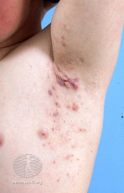Hidradenitis suppurativa of axilla | Image credit: DermNet