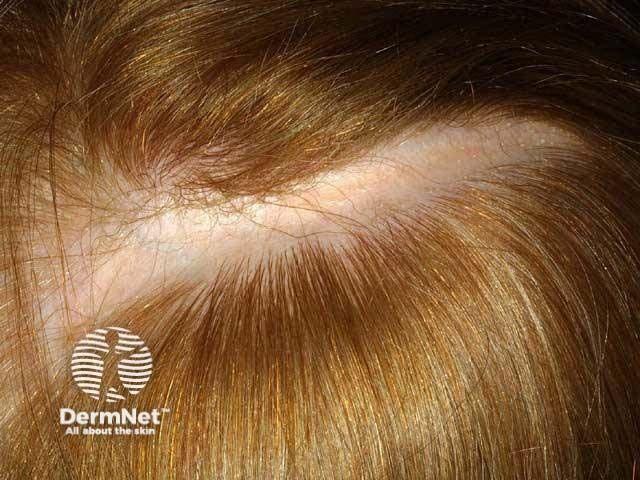 Autologous Fat Grafting Proves Promising in Treatment of Cicatricial Alopecia