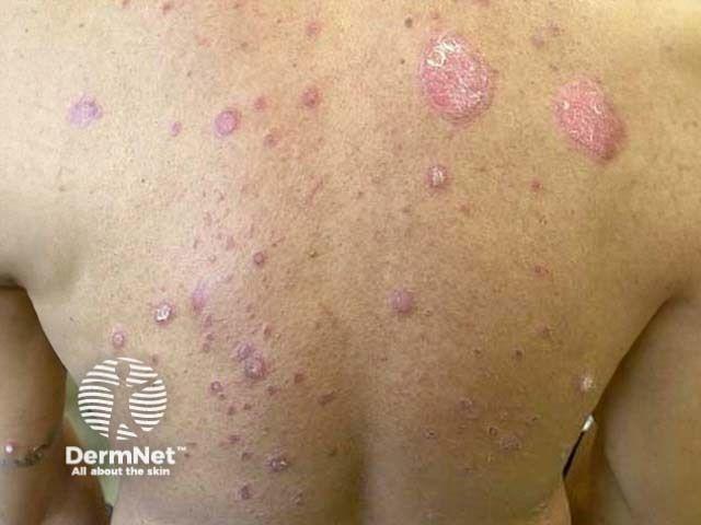 Chronic plaque psoriasis in a patient with skin of color | Image credit: DermNet