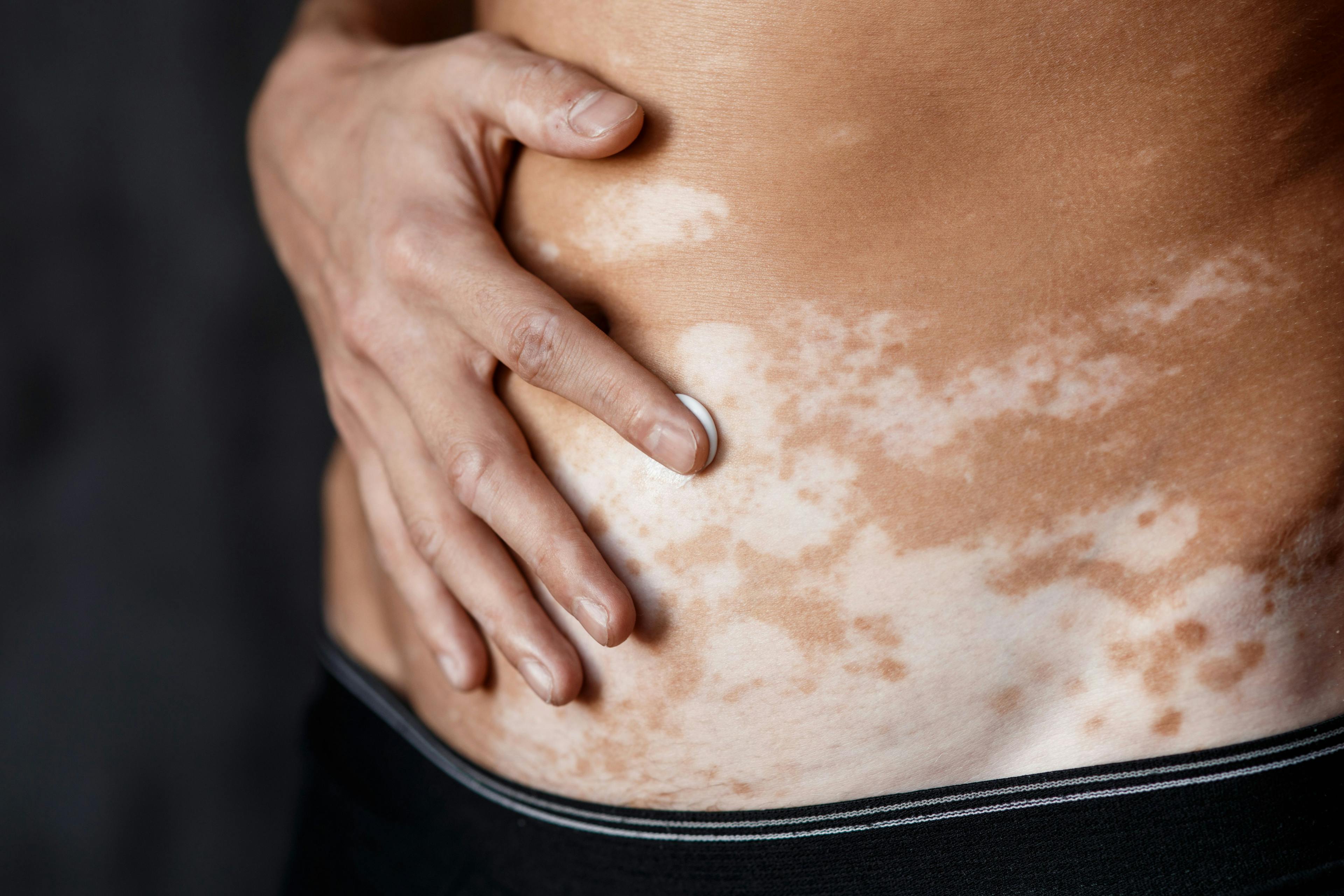 Person with vitiligo applies topical cream to stomach