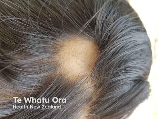 alopecia areata | Image credit: © DermNet