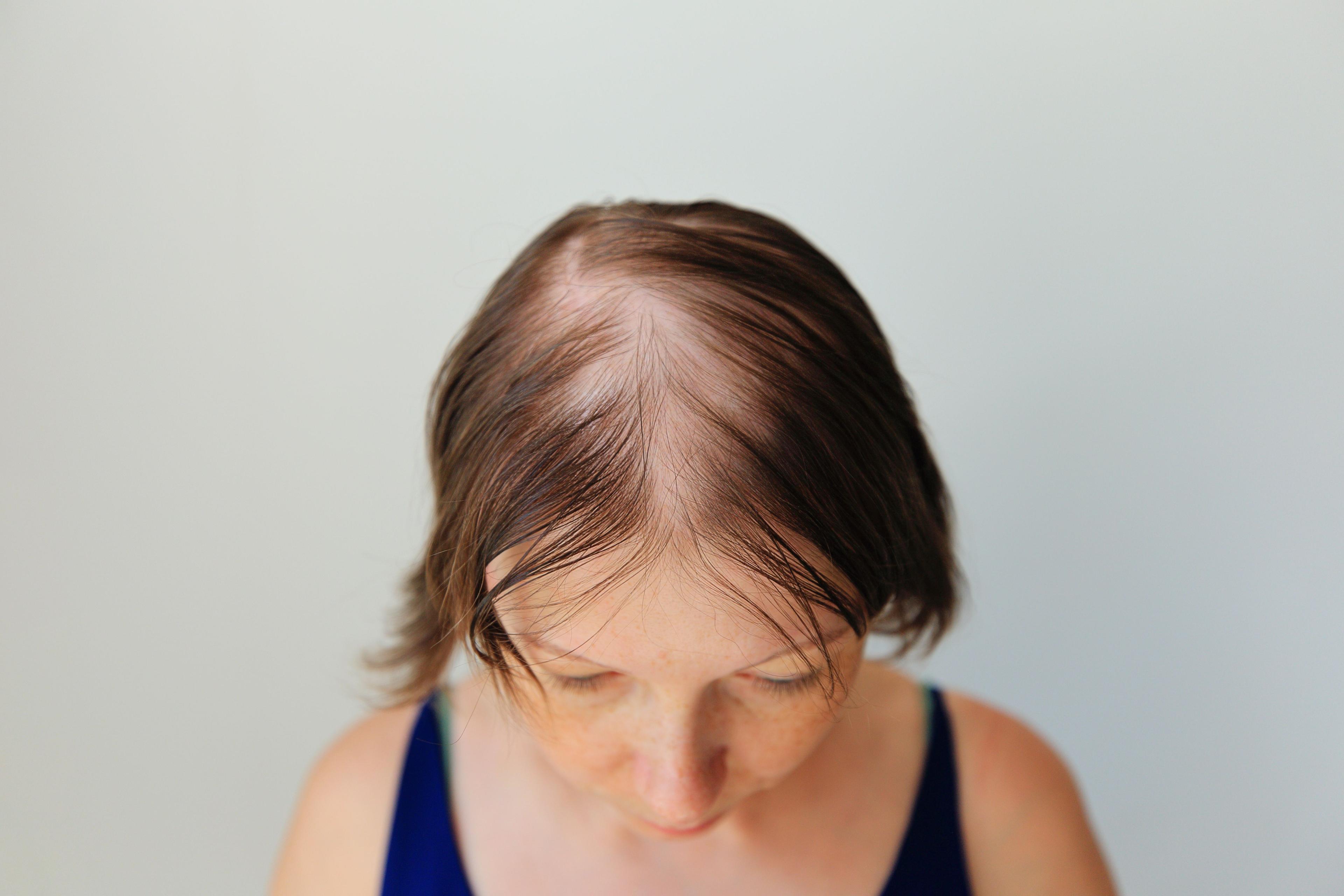 Uptitration of Baricitinib Effective in Improving Hair Growth in Patients With Alopecia Areata