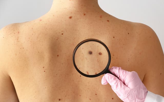 Impact of Malignant Melanoma on Employment and Work Ability