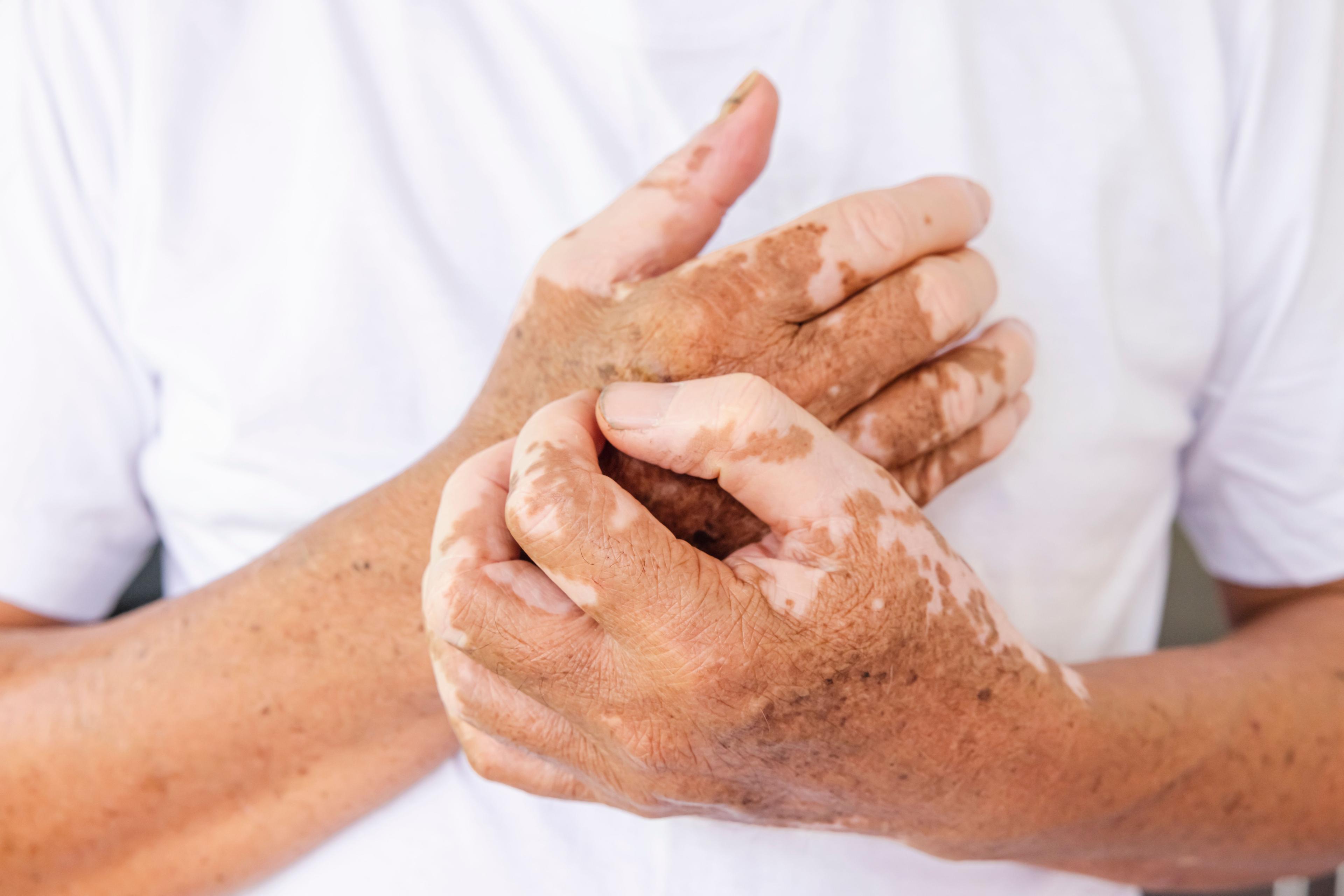 Close-up of vitiligo on the hands 