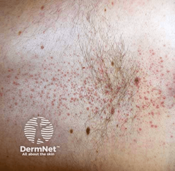 Follicular lichen planus