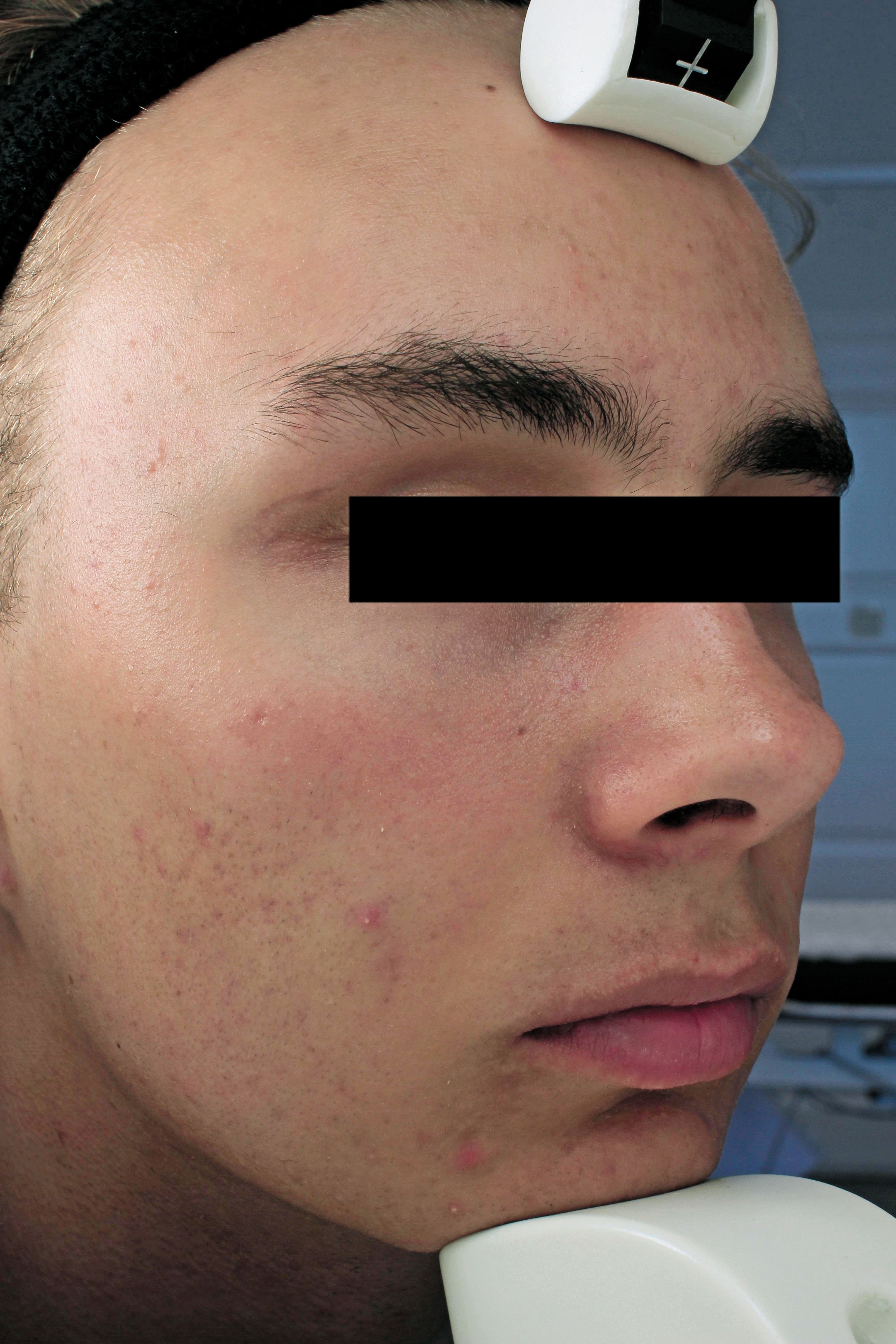 patient with acne