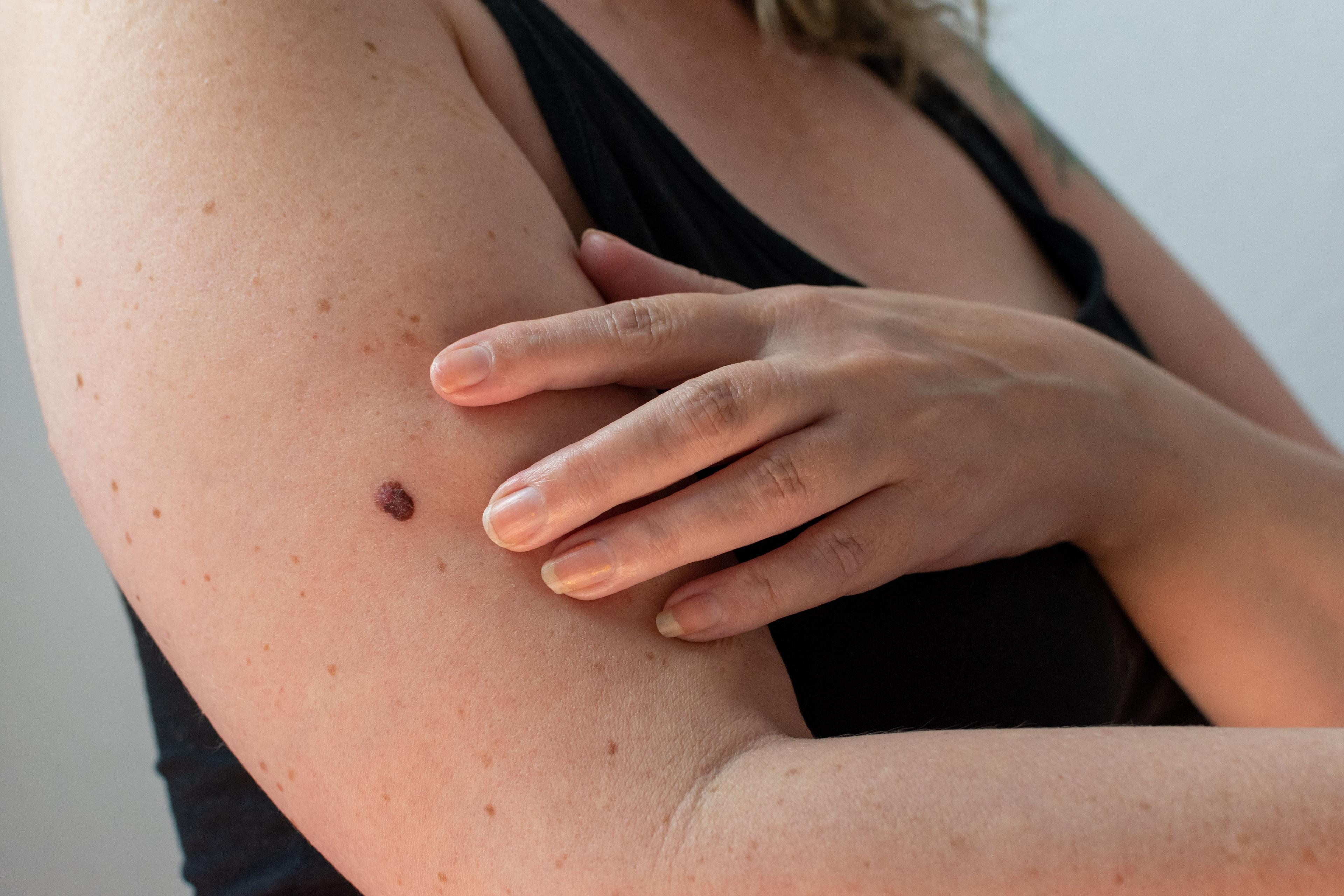 Patient with possible melanoma | Image Credit: © MW Photography - stock.adobe.com