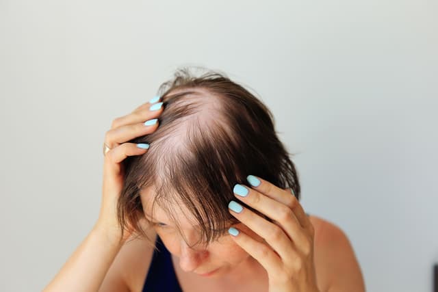 Light and Laser Therapy is an Effective Alternative for Alopecia Treatment