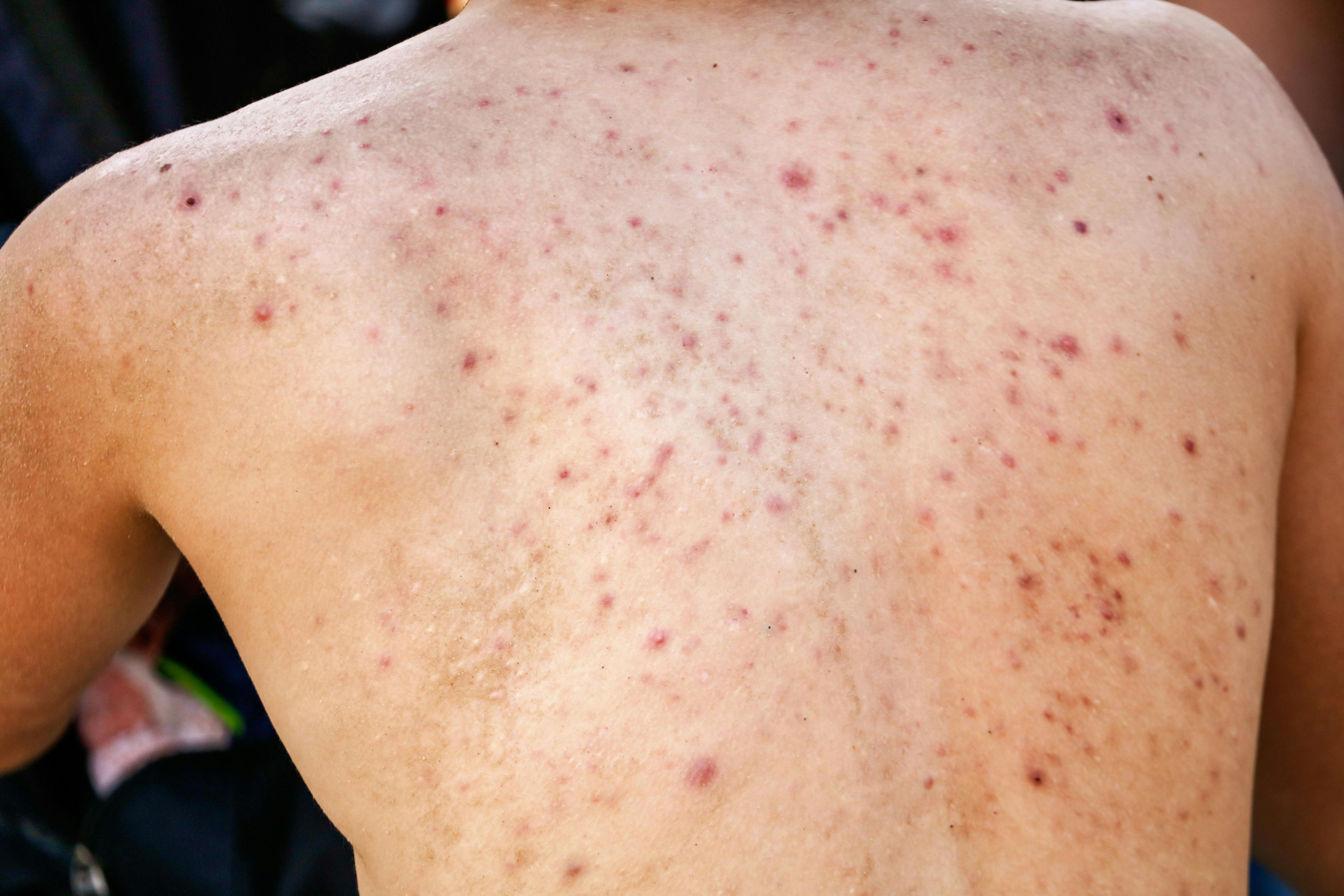 Man with acne on his back