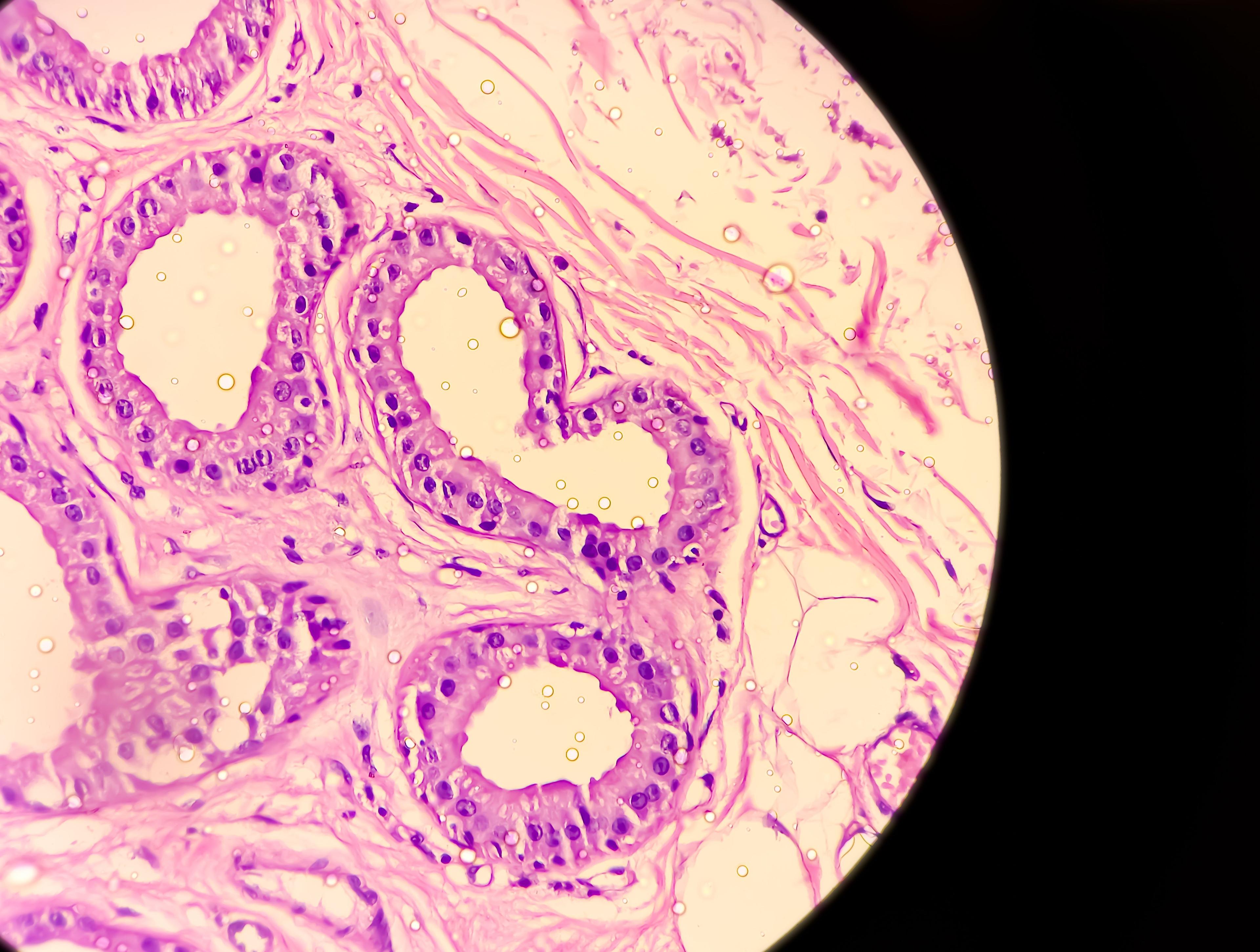 Conservative Imputation Method Efficacious in Moderate-to-Severe Hidradenitis Suppurativa