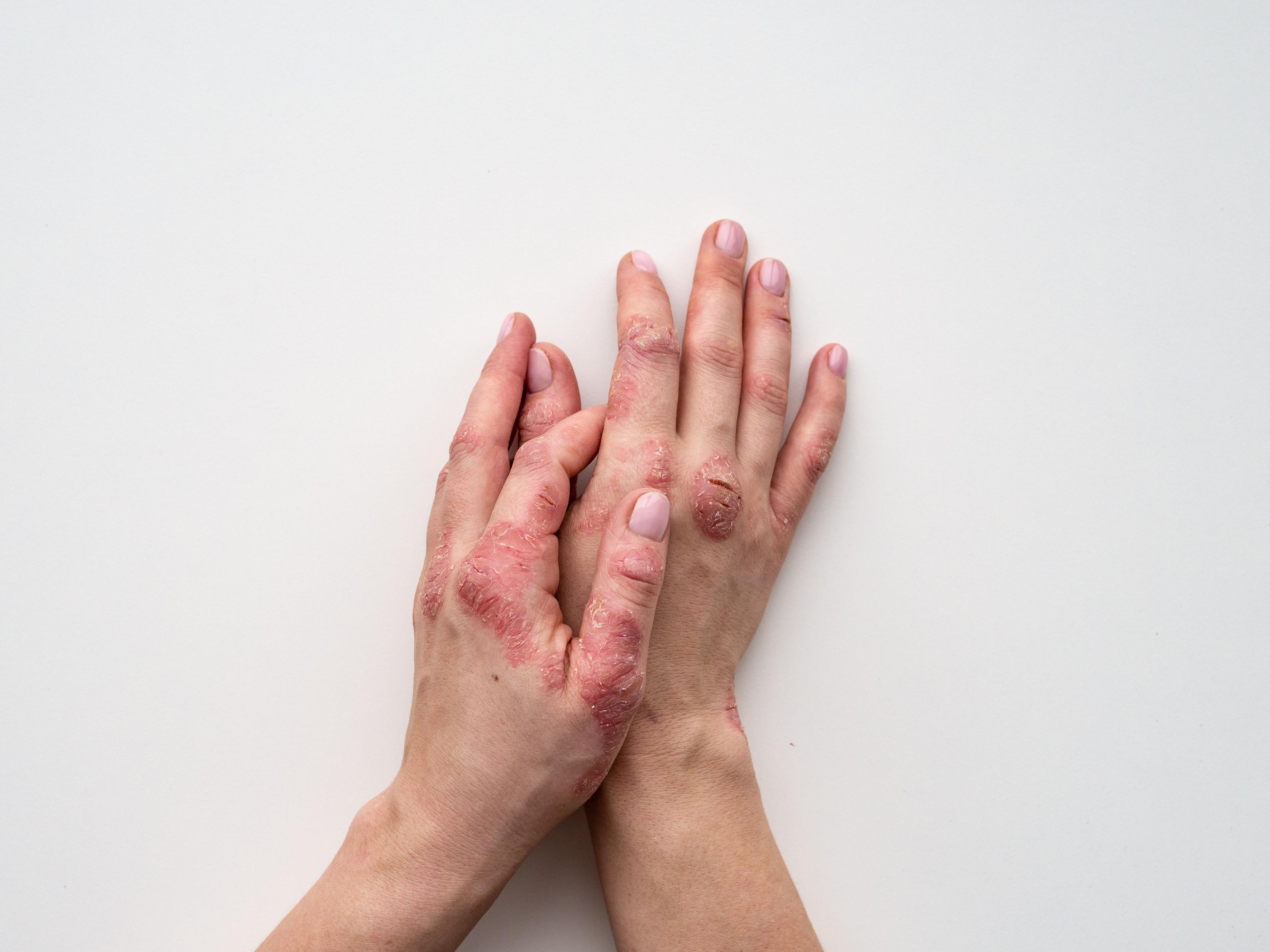 New Report Highlights Health Disparities in Psoriasis Care