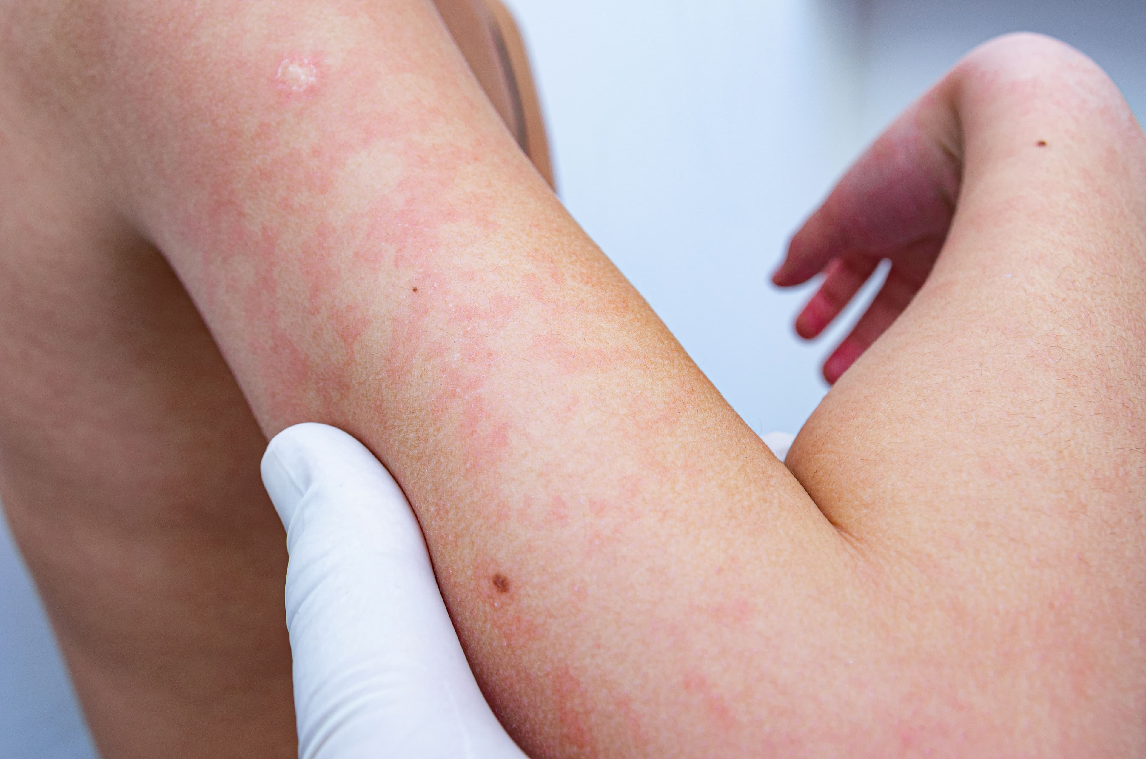 child with atopic dermatitis | Image Credit: © Evgen - stock.adobe.com