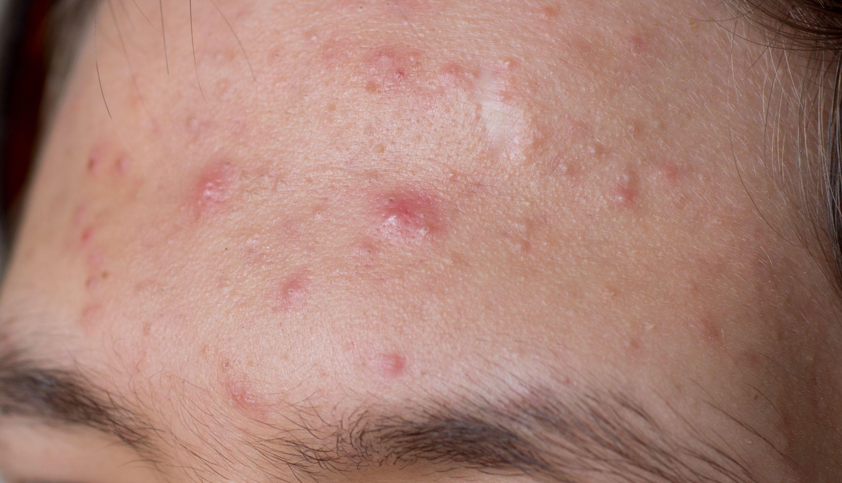 Patient with acne | Image Credit: © olavs - stock.adobe.com